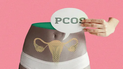 ประจำเดือนมาไม่ปกติ เสี่ยงโรค PCOS อาจมีลูกยาก แต่รักษาหายได้