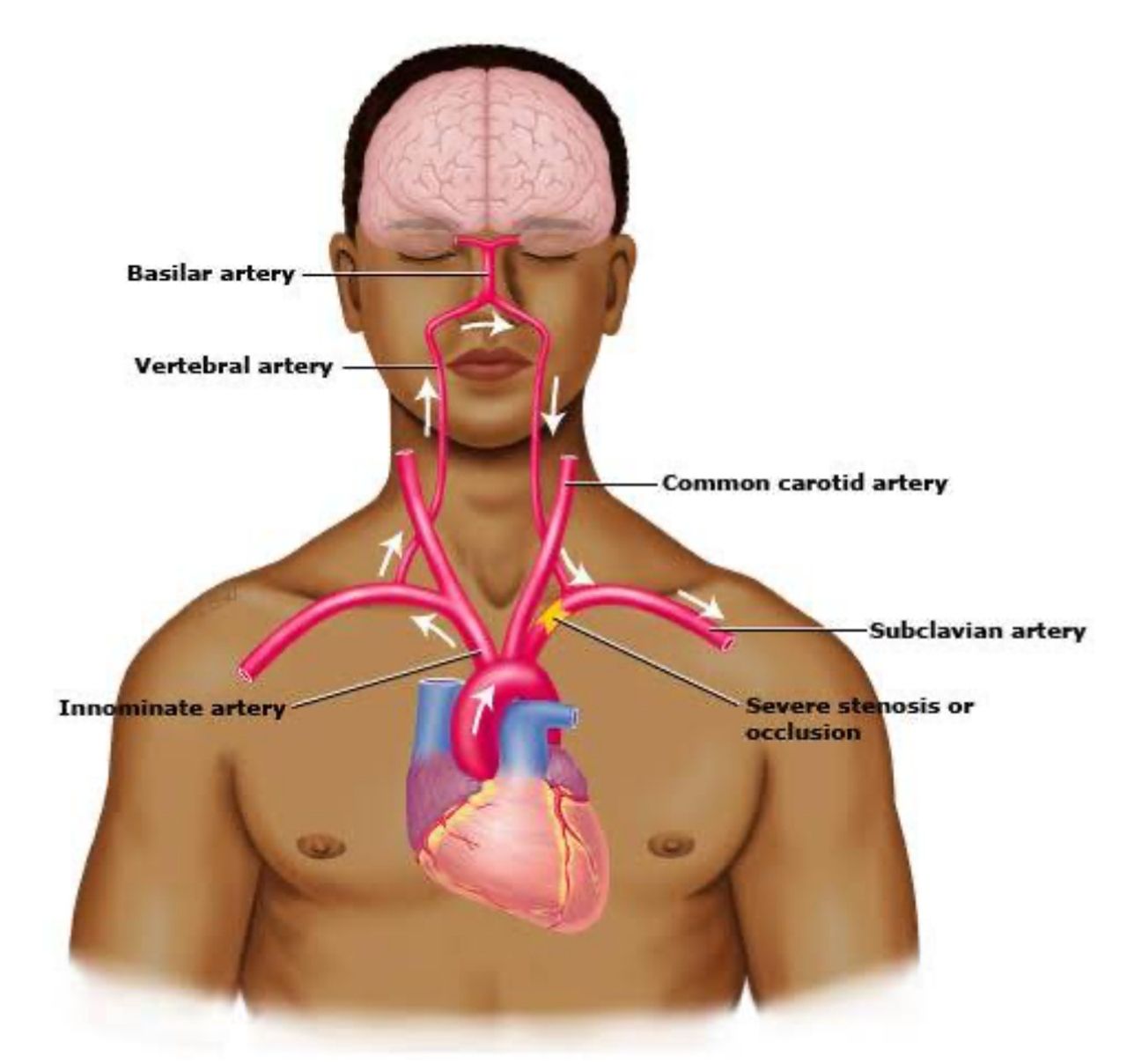 บาดแผลกระสุน ทำให้ หลอดเลือดแดงใต้กระดูกไหปลาทั้งซ้ายและขวา (Subclavian Arteries) เสียหาย เป็นเหตุให้ นายชินโสะ อาเบะ เสียชีวิต