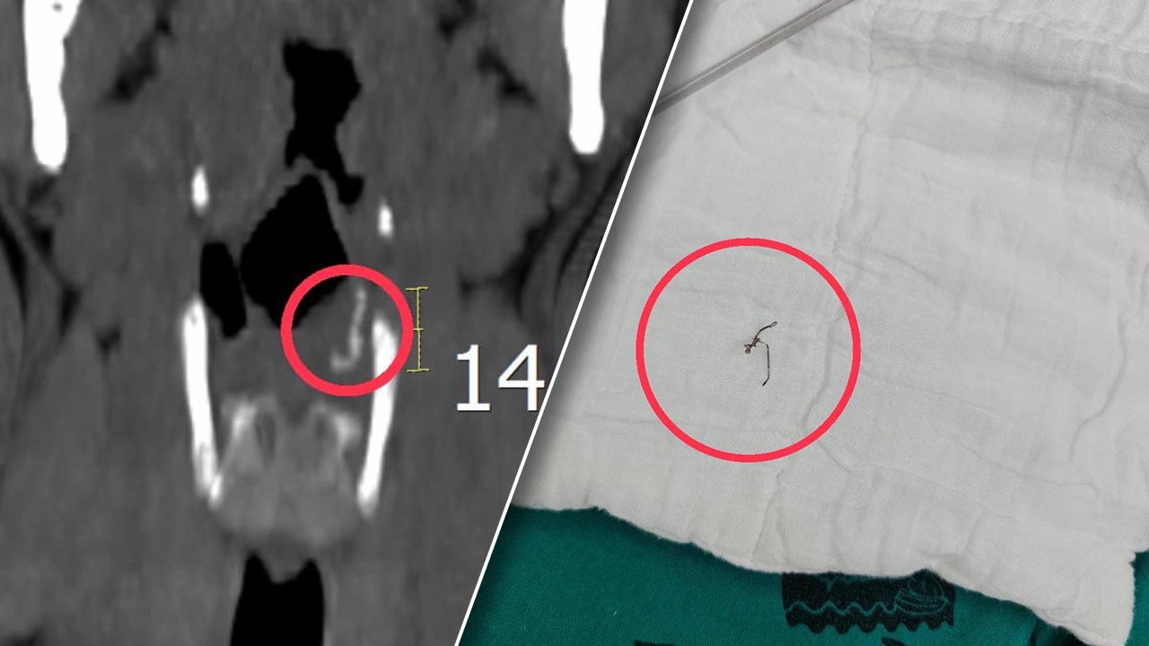อย่ามองข้าม "ฝอยขัดหม้อ" ปนในอาหาร เผลอกินแทงในลำคอ ต้องผ่าตัดฉุกเฉิน